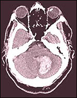 CAT-scan of a person's brain